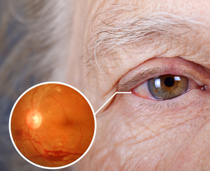 Erişkinde Diabetik Retinopati ve Tedavisi (göz içi injeksiyon, lazer veya cerrahi)