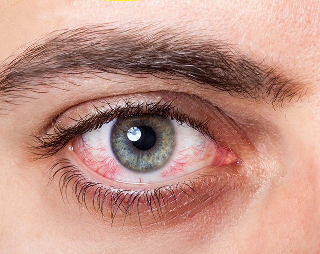 Konjonktiva Hastalıkları ve Tedavisi (Pterjium, nevüs)