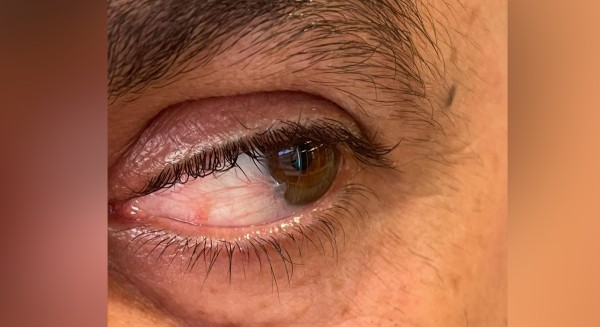 Gözde Pterjium Ameliyatı