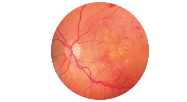Şeker Hastalığına Bağlı Retina