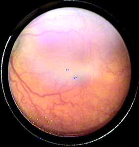 premature-retinopatisi_3