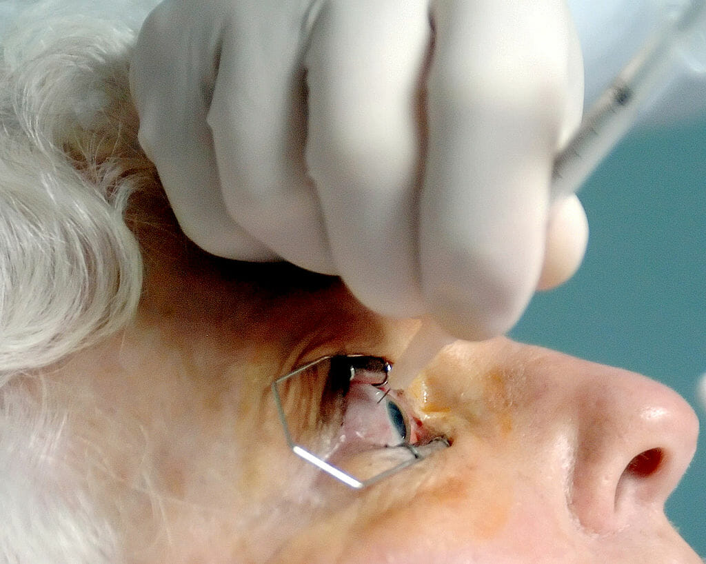 Retina Dekolmani