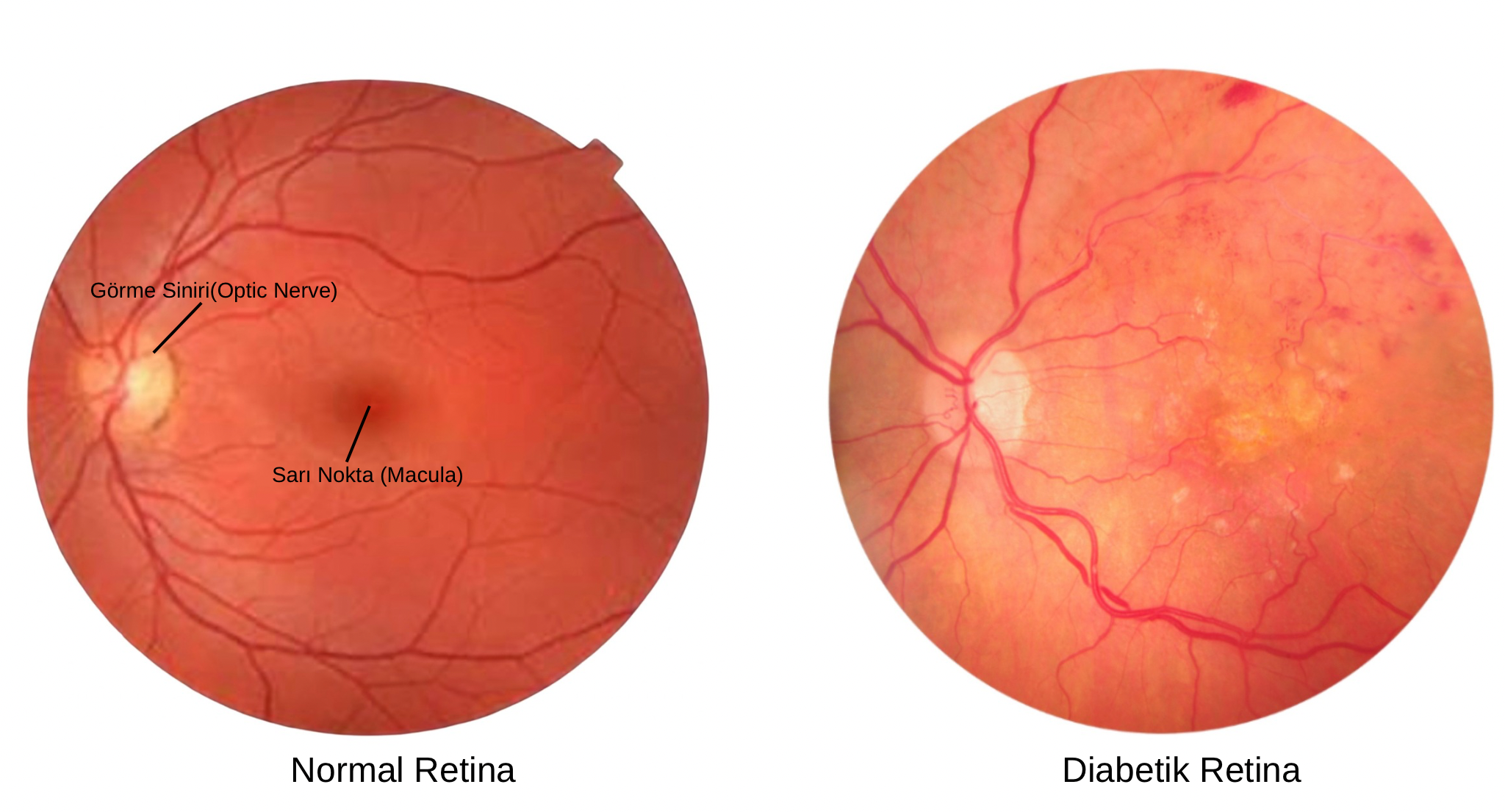 Diyabetik Retinopati