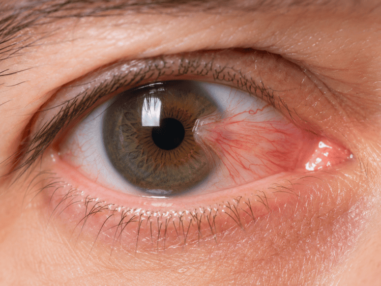 Pterjium Gözde Et Oluşumu Ve Tedavisi